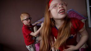 La nueva ley establece medidas adicionales de protección depersonas con albinismo a nivel educativo y laboral