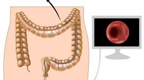 Nunca es tarde para hacerse una colonoscopia