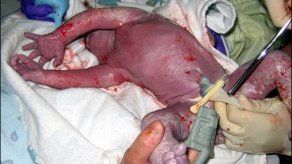 Nace primer bebé español escogido para salvar a su hermano
