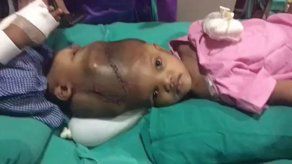 Separan en India a dos siameses unidos por la cabeza