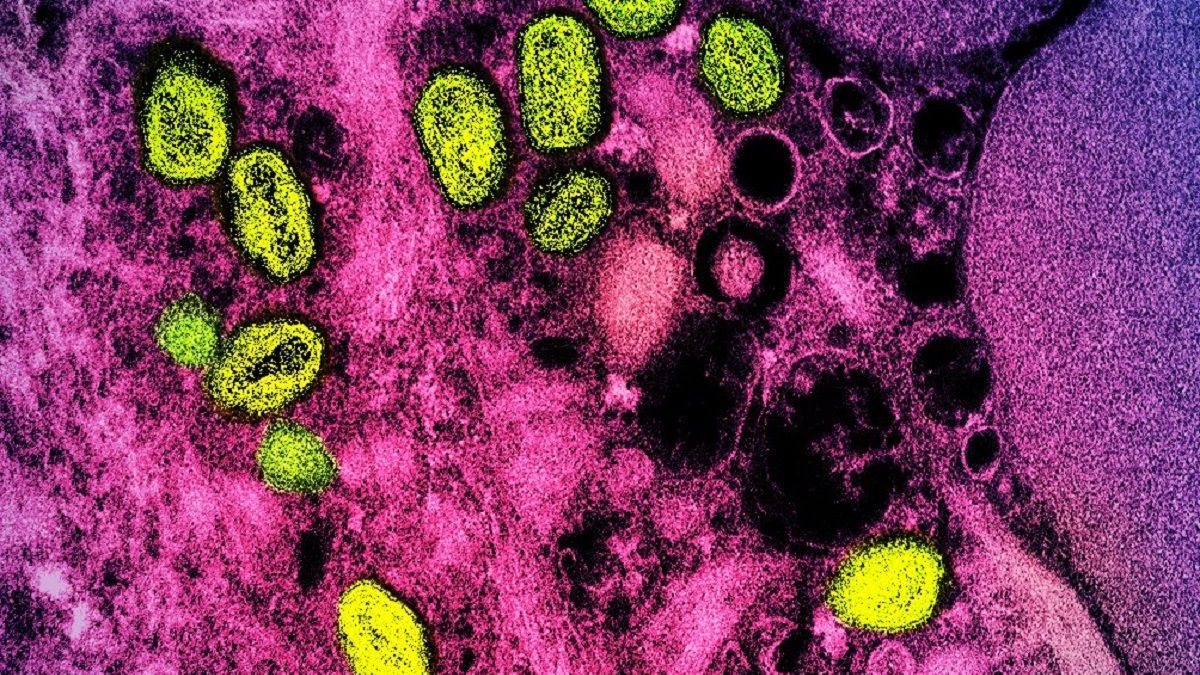 Virus de la viruela del mono.