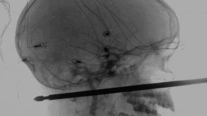 Niño sobrevive luego que brocheta le atraviesa la cabeza