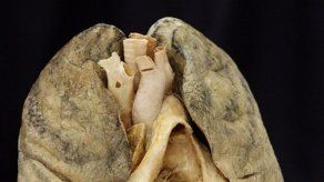 El cáncer de pulmón