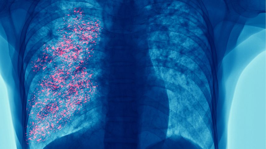 En Panamá, se registran 370 casos nuevos y más de 300 defunciones cada año. En Panamá, se registran 370 casos nuevos y más de 300 defunciones cada año.