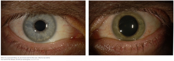 Detectan ébola en el ojo de un paciente curado