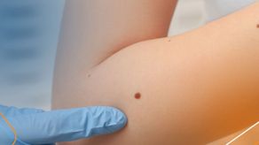 Lunares en la piel, cómo detectarlos.