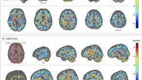 Misterio sobre dolencia de diplomáticos de EEUU en Cuba