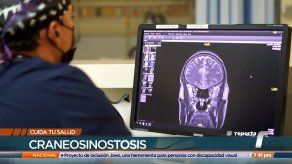 Cuida tu salud: craneosinostosis