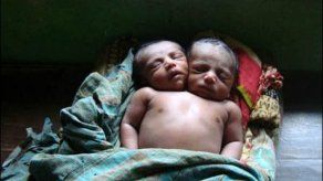 Muere el bebé nacido con dos cabezas en Bangladesh