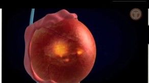 Cáncer de testículos