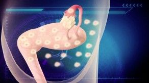 Cuida tu Salud: Endometriosis, más allá del dolor