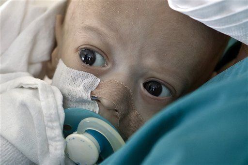 Nueva esperanza para bebé rumano con intestinos atrofiados