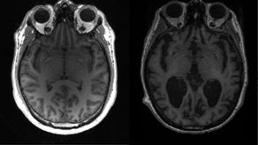 Un estudio genético revela la relación entre la salud del cerebro e intestino