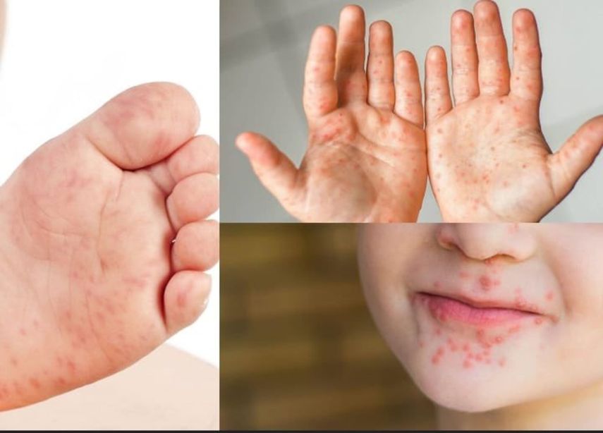 Síntomas del virus boca