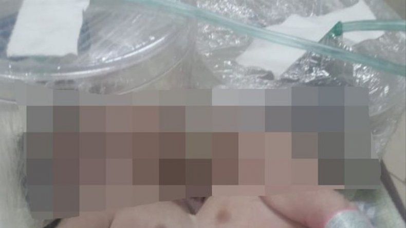 Mueren en Honduras siamesas unidas por el tórax y que compartían el corazón