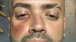 ¿Qué le ha pasado en la cara al cantante Nacho Mendoza?