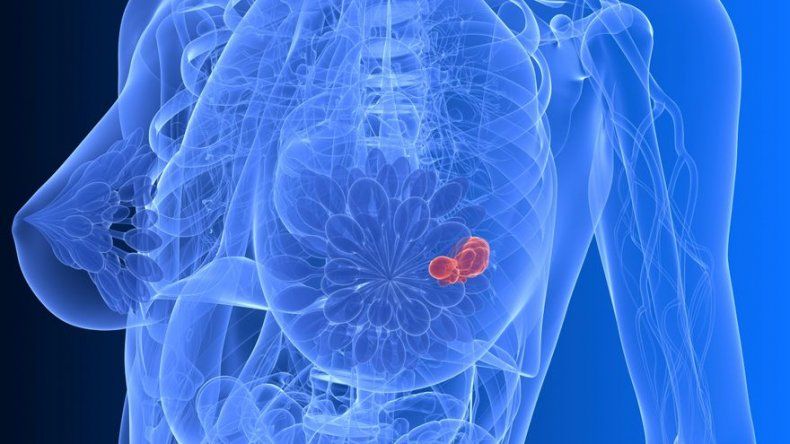 Estudio: Sobrediagnóstico de cáncer cuesta 4.000 millones