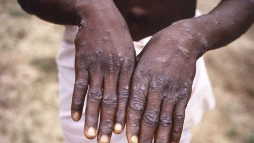 En la actualidad hay más de 15.000 casos de viruela del mono en todo el mundo.
