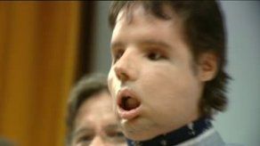 Paciente con rostro transplantado es mostrado a la prensa