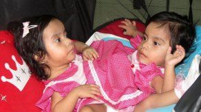 Separan con éxito a siamesas en Guatemala