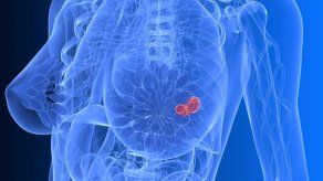 Estudio: Sobrediagnóstico de cáncer cuesta 4.000 millones