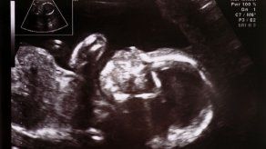 ¿De qué se trata el análisis que detecta enfermedades genéticas del bebé?