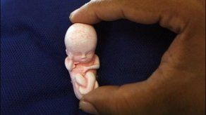 Brasil: juez autoriza aborto de feto sin cerebro