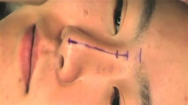 Video: Cirugía de levantamiento de párpados, auge en Asia