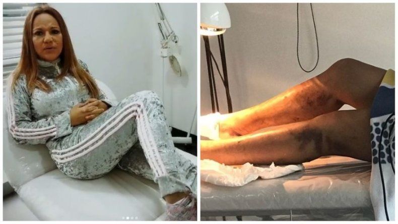 Sandra Sandoval tuvo que viajar a Bogotá para retirar silicona de sus piernas