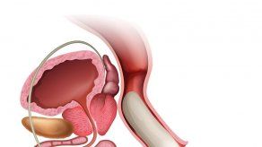 ¿Cómo diagnosticar el cáncer de próstata?
