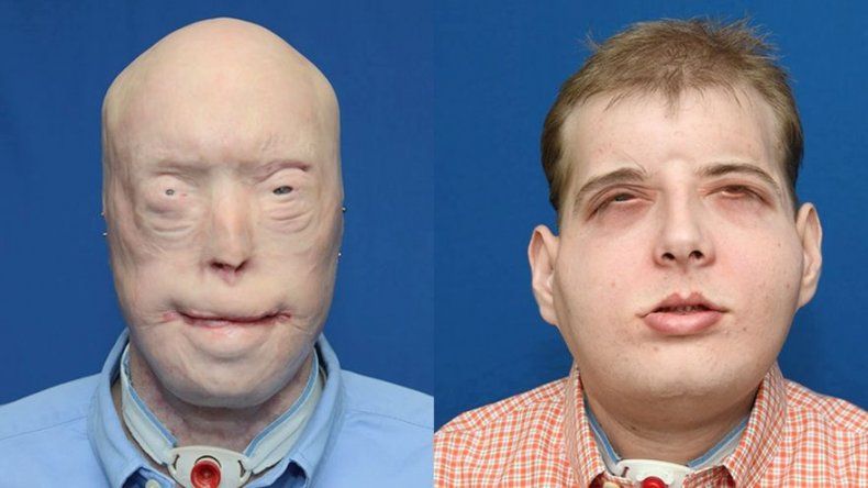 Médicos de Nueva York practican complejo trasplante de rostro