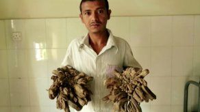 Hospital de Bangladesh se prepara para operar al hombre árbol