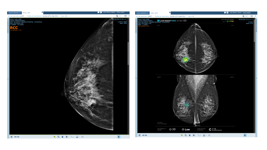 Maxia ha incorporado algoritmos avanzados que permiten la detección temprana de cáncer de mama. Maxia ha incorporado algoritmos avanzados que permiten la detección temprana de cáncer de mama.
