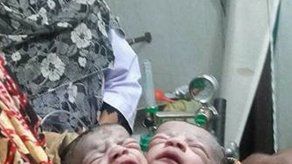 Nace un niña con dos cabezas en Bangladesh