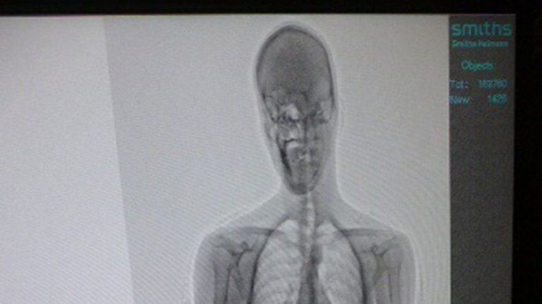 Descubren una llave para abrir esposas en el estómago de un preso uruguayo