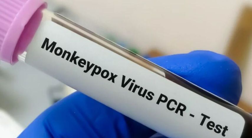 El doctor explicó que la viruela del mono y la contagiosidad duran y&nbsp; permanece hasta que se cae la última costra. Esto dura aproximadamente de 2 a 4 semanas.