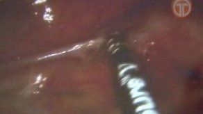 El cáncer de colon es tratado con nuevos métodos