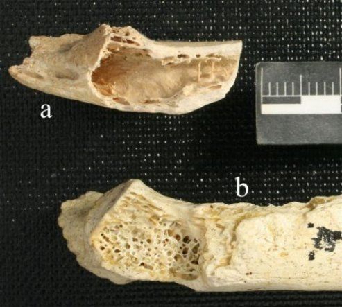 Hallan el cáncer de huesos en un Neanderthal de hace 120.000 años