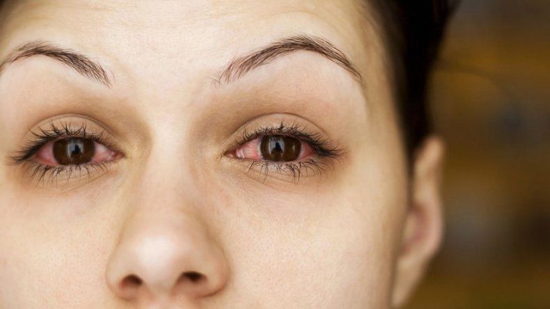 Reportan 938 casos de conjuntivitis en Colón, piden mantener medidas de higiene