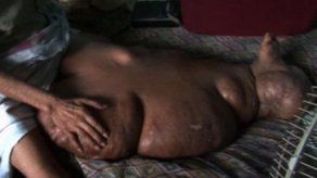 Colombino Marín: el hombre de la pierna gigante