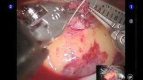 Con éxito termina primera cirugía robótica practicada a niño en A.Latina