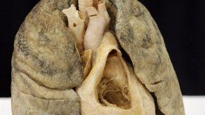 Científicos británicos trazarán un mapa genético del cáncer pulmonar
