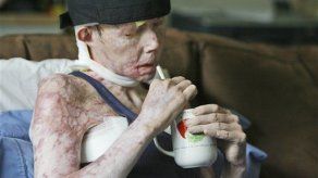 Trasplantan rostro a mujer desfigurada con lejía