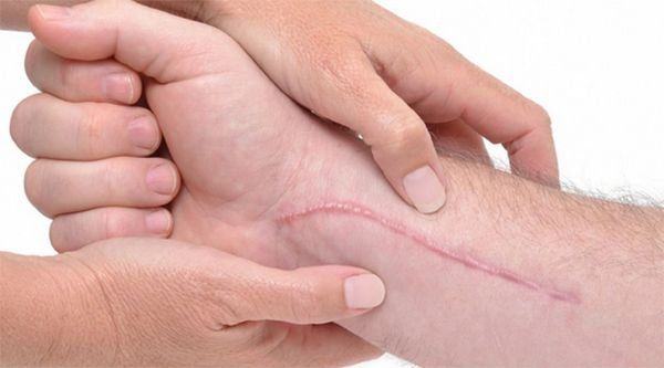 CSS advierte de aumento de casos de adolescentes con trastorno del Cutting que se autolesionan
