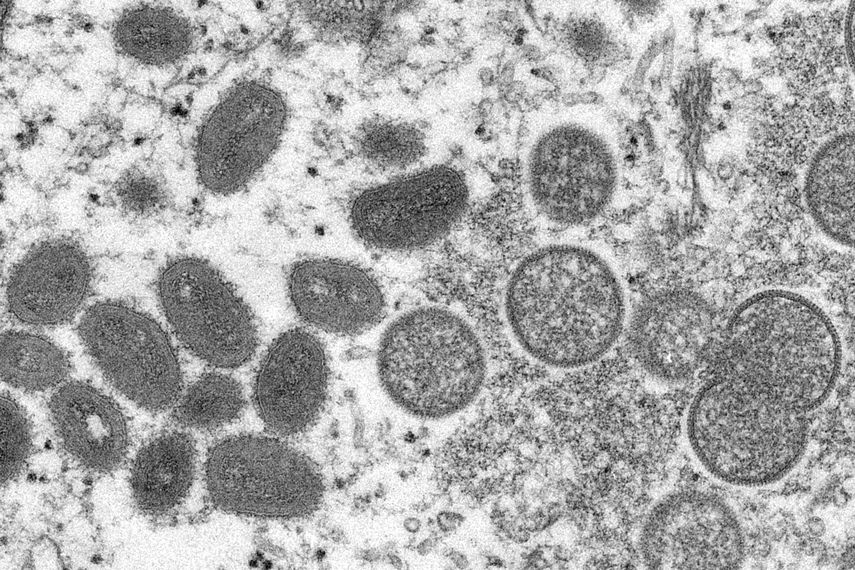 Confirman primer caso de viruela del mono en Chile