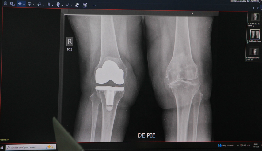 Hospital Santo Tomás inicia jornada gratuita de reemplazo de rodilla
