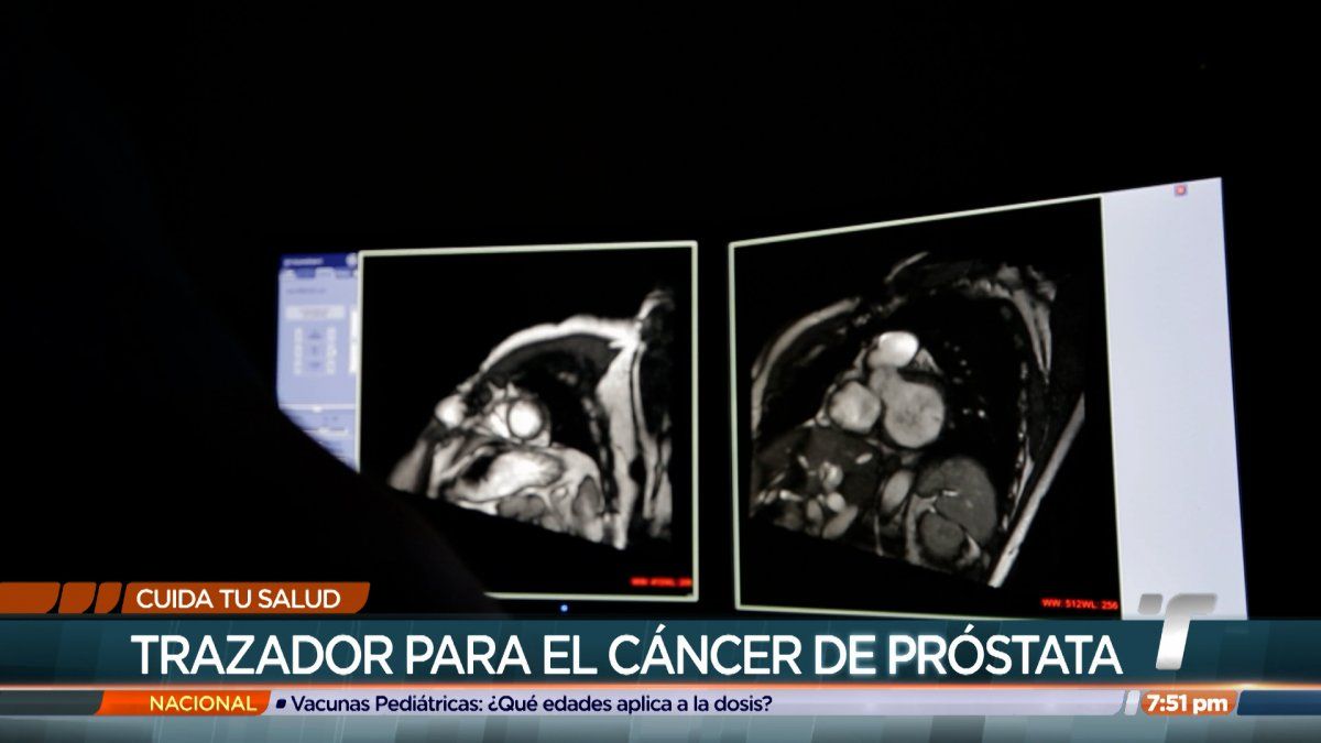 Cuida Tu Salud Trazador Para El Cáncer De Próstata 1103