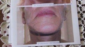 Mujer resultó con severos daños en rostro y orejas, tras mala praxis