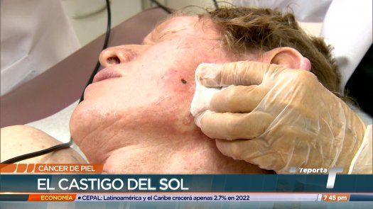 Cáncer de piel: El castigo del sol
