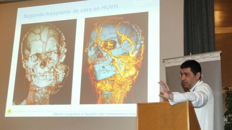Reconstruyen la cara a un hombre con tumor en boca, lengua, cuello y faringe